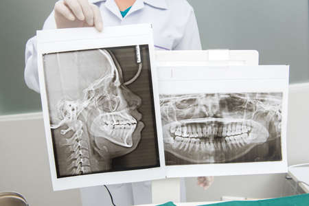 Panoramic x-ray jaw. A dentist holding an x-ray the patient's tooth