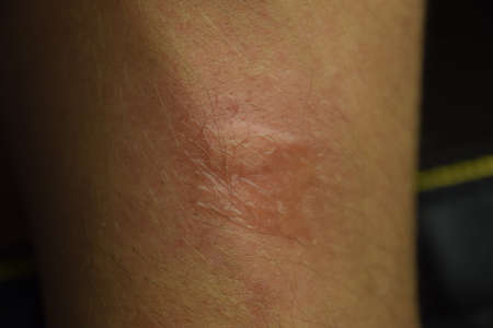 Allergy skin. Allergic reactions on the skin in the form of swelling and redness.
