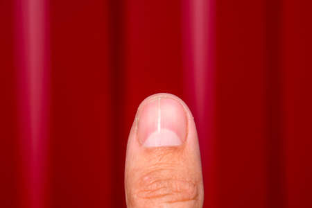 Forked nail on the thumb. Dilation of the nail, traumatic pathology. The nail is divided in half.の写真素材