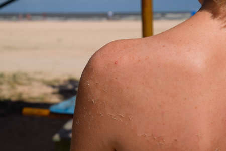 Sunburn on the skin of the back. Exfoliation, skin peels off. Dangerous sun tan.の写真素材