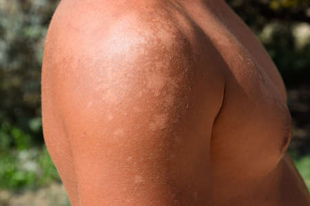 Sunburn on the skin of the shoulders. Exfoliation, skin peels off. Dangerous sun tan.の写真素材