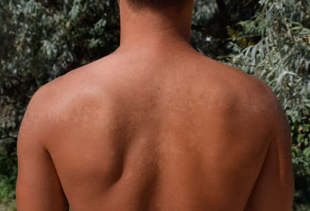 Sunburn on the skin of the back. Exfoliation, skin peels off. Dangerous sun tan.の写真素材
