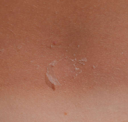 Sunburn on the skin of the back. Exfoliation, skin peels off. Dangerous sun tan.