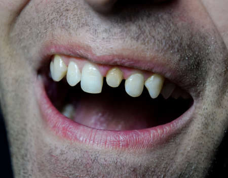 The process of replacing a tooth. Preparation of the tooth under the crown. Pin in the toothの写真素材