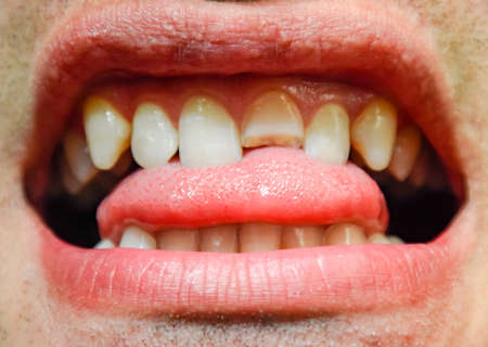 Broken tooth. Broken upper incisor in a man mouth. Man shows oral cavity to the dentist. Treatment of a broken tooth.の写真素材