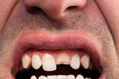 Broken tooth. Broken upper incisor in a man mouth. Man shows oral cavity to the dentist. Treatment of a broken tooth.の写真素材