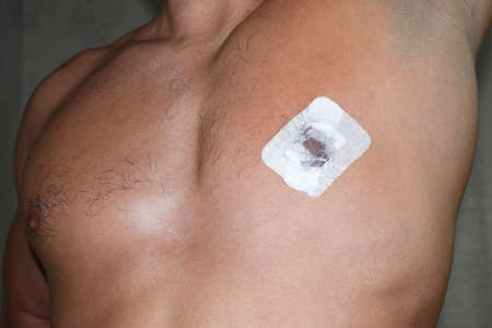 Bactericidal adhesive tape on the male nipple. Dressing after surgery on the nipple areola.の写真素材