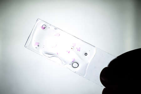 Slices of the tumor under glass. Histological examination of tumor cells for the presence of cancer....