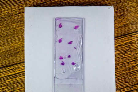 Slices of the tumor under glass. Histological examination of tumor cells for the presence of cancer....