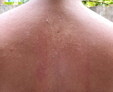 Exfoliation of the skin after sunburn. Excessive tan. The effects of sunburn on the skin. Climb skin.の写真素材