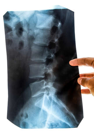 X-ray of the lumbar spine, spine on x-rayの写真素材
