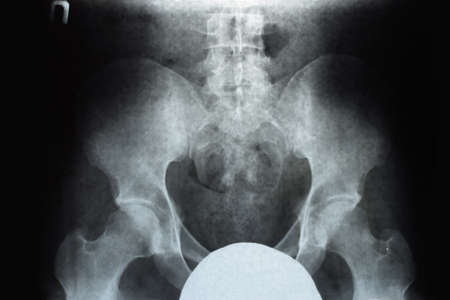 X-ray of the pelvis and sacrum. X-ray image.
