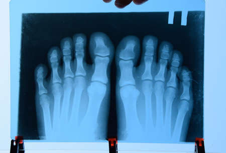 X-ray of toes. Foot on X-ray. bone research