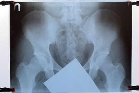 X-ray of the pelvis and sacrum. X-ray image.の写真素材