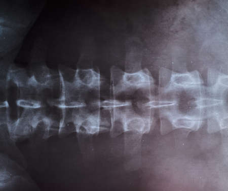X-ray of the lumbar spine, spine on x-rayの写真素材