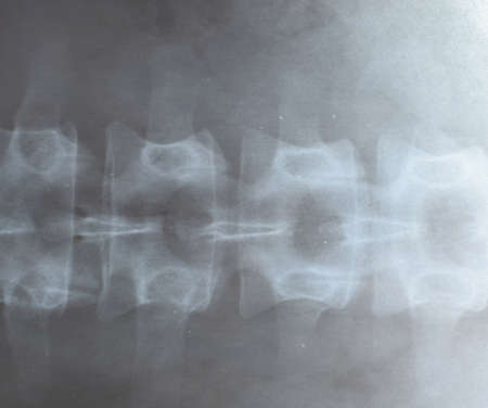 X-ray of the lumbar spine, spine on x-rayの写真素材