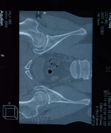 MRI sacroiliac articulation. Study of ankylosing spondyloarthritis patient. The results of the study...