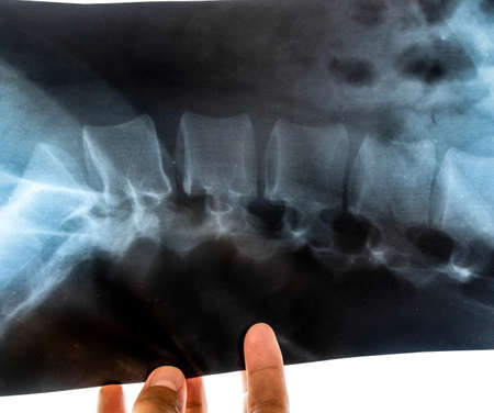X-ray of the lumbar spine, spine on x-rayの写真素材