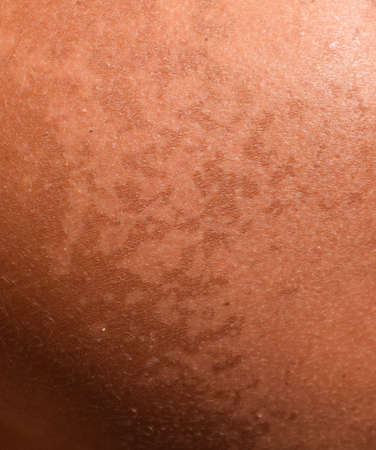 Sunburn on the skin of the shoulders. Exfoliation, skin peels off. Dangerous sun tan.