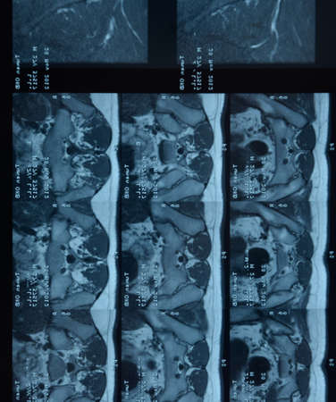 MRI sacroiliac articulation. Study of ankylosing spondyloarthritis patient. The results of the study on the x-ray.の写真素材
