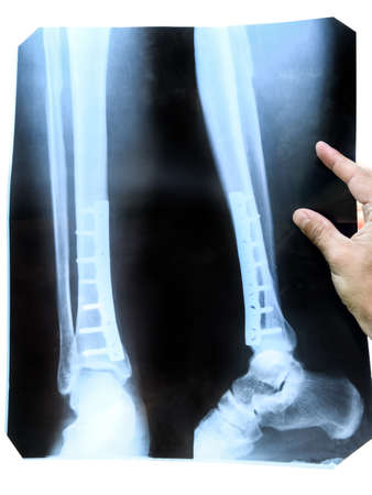 x-ray of the leg. A steel plate holding together the tibia of the leg.