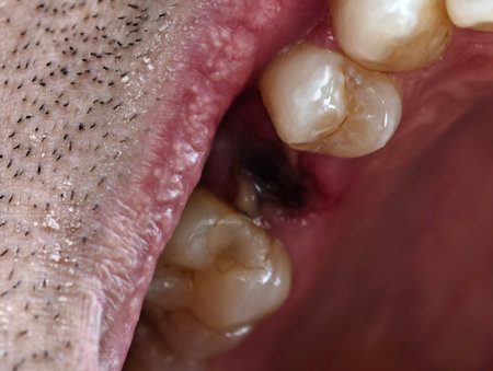 open mouth of a man with the place of a pulled out small molar tooth, healing of a wound in the...