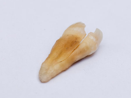 Pulled out cracked and damaged tooth, second premolar on a white backgroundの写真素材