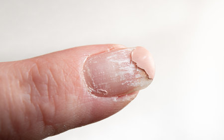 Close up view of layers peeling off damaged finger nail after UV nail polish usage. Home indoors.の写真素材