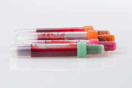 Blood samples are on a laboratory form for Finding out the blood valuesの写真素材