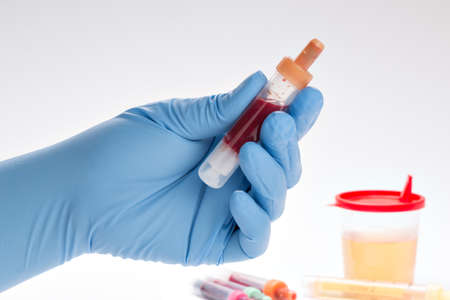 Urine and blood sample on a form for examination