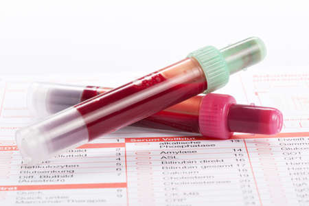 Blood samples are on a laboratory form for Finding out the blood valuesの写真素材