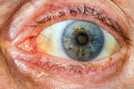 Reddened eyes of an elderly man with glaucomaの写真素材