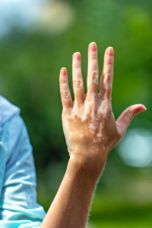 A person's hand with a visible skin conditionの写真素材