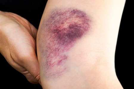 Close up of a hematoma on woman arm near elbow.の写真素材