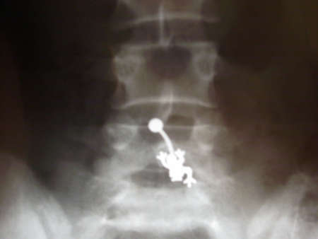 x-ray photo of a backbone,an x-ray of a chest, ribs and abdomen,x-ray of chest of healthy patient,