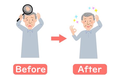 Before-after vector illustration of Grandpa suffering from thinning hair of the headのイラスト素材