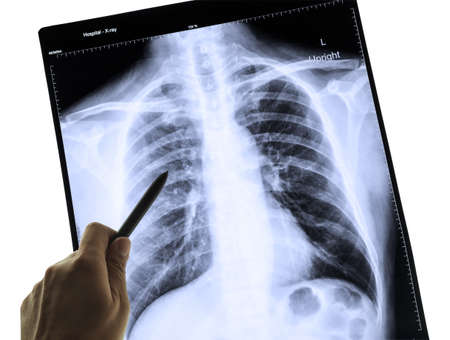 X-Ray Image Of Human Chest for a medical diagnosis and hand pointingの写真素材