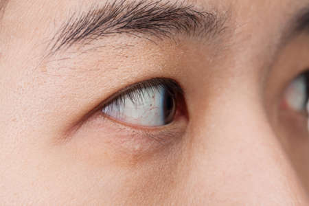 Eye injury or infected for healthy concept, macro closeupの写真素材