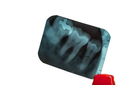 tooth and overlapping teeth in X-ray film showing and tweezer on white backgroundの写真素材