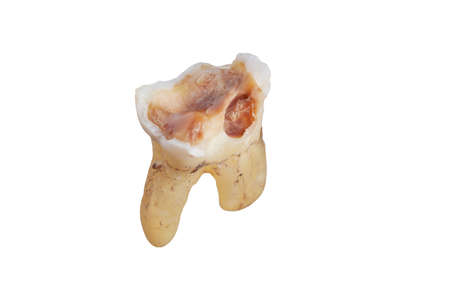 human tooth cracked and tooth pain isolated on white background, dental conceptの写真素材