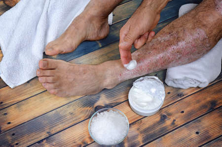 A person suffering from chronic psoriasis relaxes during treatment with salts and creams of inflammation on an antique wooden table.の写真素材