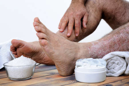 A person suffering from chronic psoriasis relaxes during treatment with salts and creams of inflammation on an antique wooden table.の写真素材
