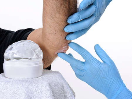 The dermatologist with gloves protected hands studies inflammation in the left elbow of an adult man with psoriasisの写真素材