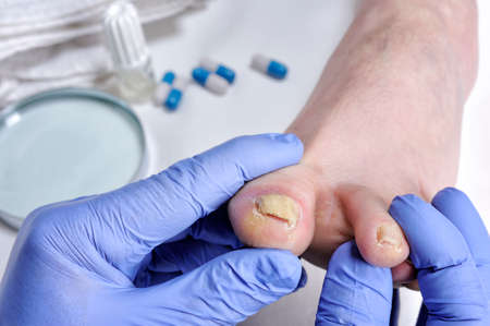 Dermatologist doctor visits the nails of a patient affected by onychomycosis following the action of pathogenic fungi.の写真素材