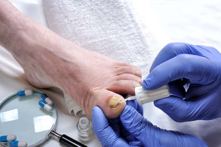 Dermatologist doctor treats a nail affected by onychomycosis following the action of pathogenic fungi.の写真素材