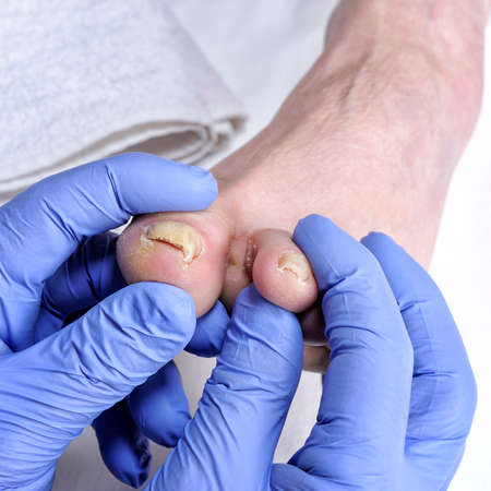 Dermatologist doctor visits the nails of a patient affected by onychomycosis following the action of pathogenic fungi.の写真素材