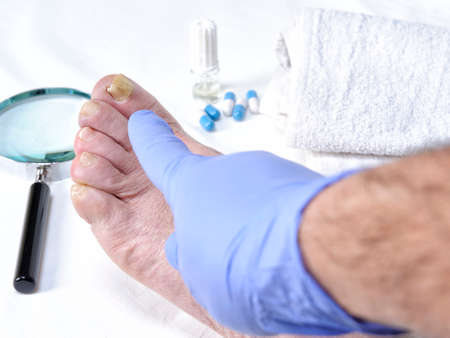 Dermatologist doctor visits the nails of a patient affected by onychomycosis following the action of pathogenic fungi.の写真素材