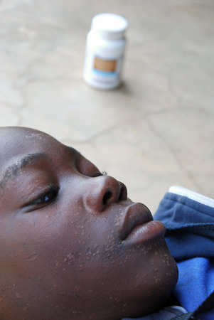28 August 2014 - Hospital of Iringa-Iringa-Tanzania-Africa-The face of an unidentified child ravaged by the HIV virus; in the background the antiretroviral drugs to fight the disease,  just received from doctors at the hospital in Iringaのeditorial素材