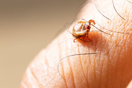 Tick filled with blood sitting on human skin.の写真素材