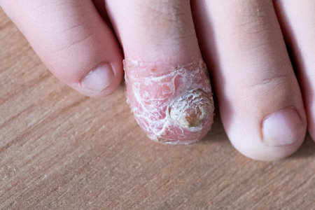 Fungus on child  toe. Skin diseases.の写真素材